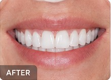 Illustrative cosmetic dentistry after example