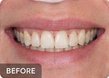 Illustrative cosmetic dentistry before example