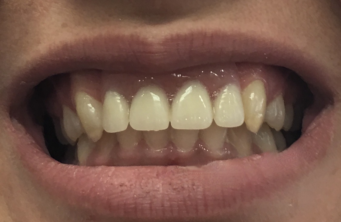 After dental implant restorative case