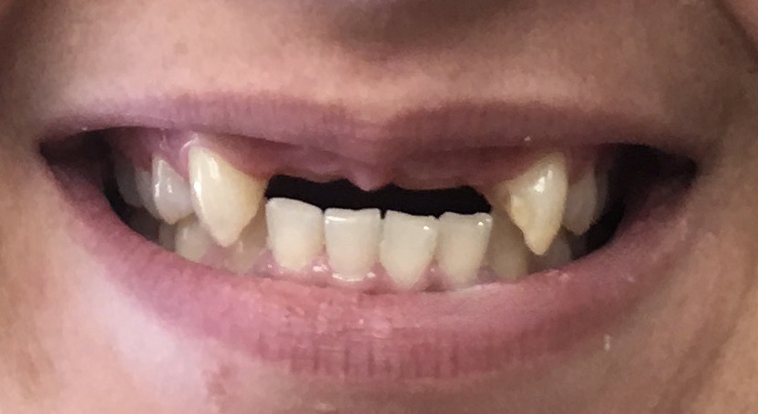 Before dental implant restorative case